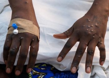 GHS Confirms 6 Additional Mpox Cases, Ghana’s Count Now at 85